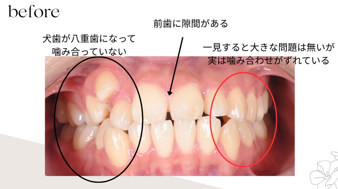 矯正治療