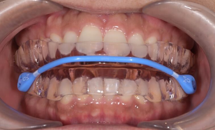 マウスピース治療（OA療法）